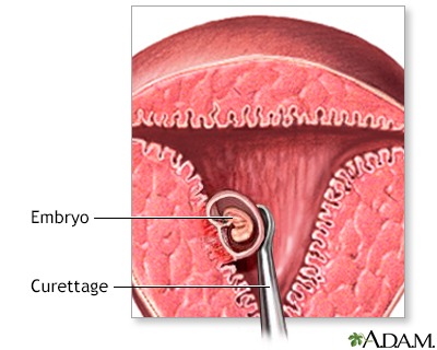 ABORTIONS