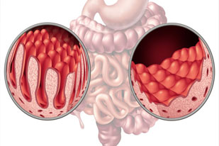 MALABSORPTION SYNDROME