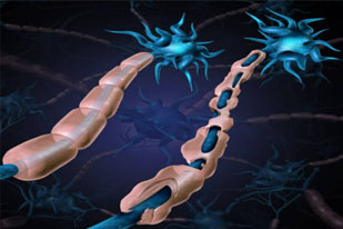 MULTIPLE SCLEROSIS