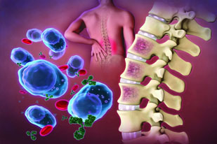 MULTIPLE MYELOMA