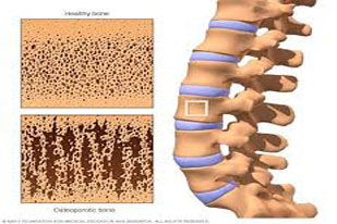 OSTEOPOROSIS
