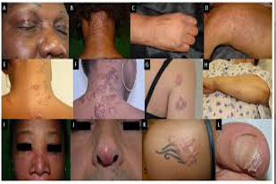 SARCOIDOSIS
