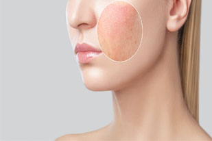 DISORDER OF SKIN