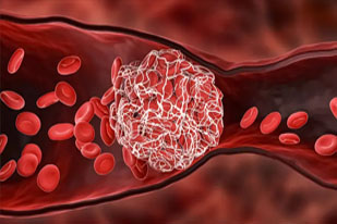 THROMBOEMBOLIC DISORDER