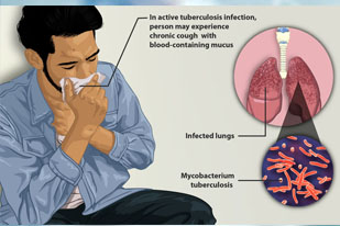 TUBERCULOSIS
